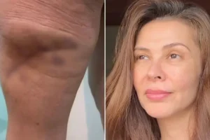 MP denuncia dona de clínica de estética por necrose em modelo em SC