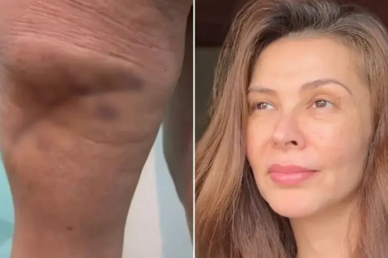 MP denuncia dona de clínica de estética por necrose em modelo em SC