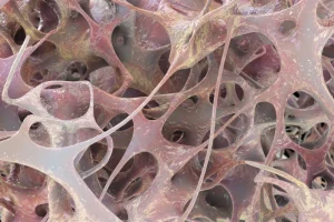 Conheça agora os 3 sintomas da osteoporose com ortopedista e fisiatra