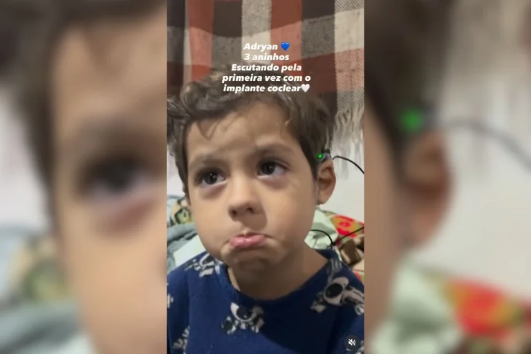 Reação de bebê ao ouvir pela 1ª vez após implante coclear viraliza
